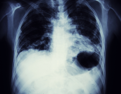 physicians use xray to diagnose mesothelioma