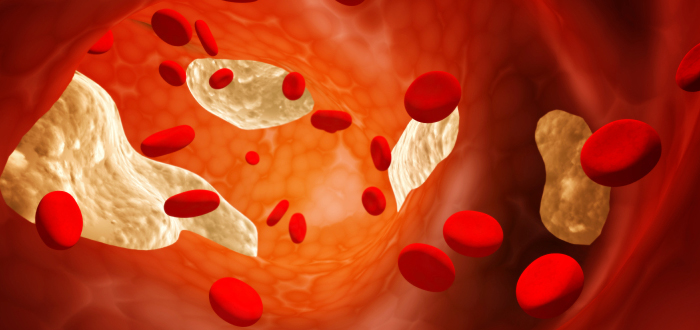 Low Cholesterol Doesn't Help Mesothelioma