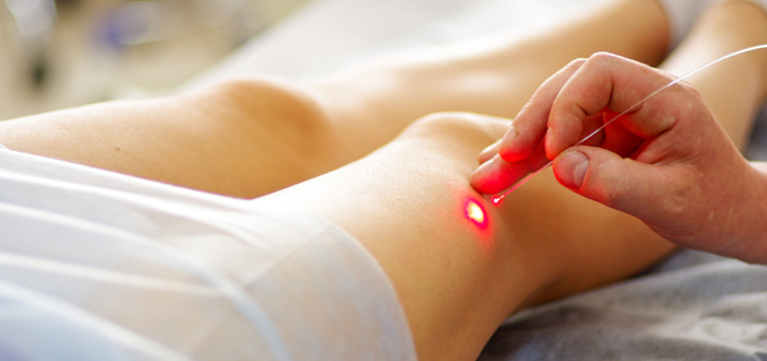 Varicose laser treatment