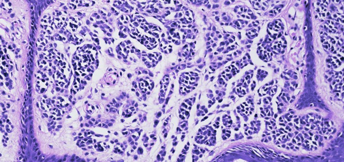 Cell Block Thoracentesis Mesothelioma Diagnoses