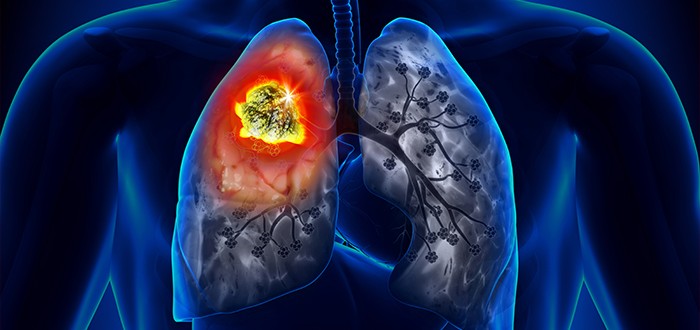 Inflamed Mesothelioma Tumors and Immune Escape