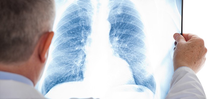 Reliable Mesothelioma Diagnosis May Be Possible Without a Biopsy