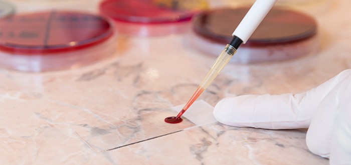Blood Test May Detect Mesothelioma Years Before You Know You Have It