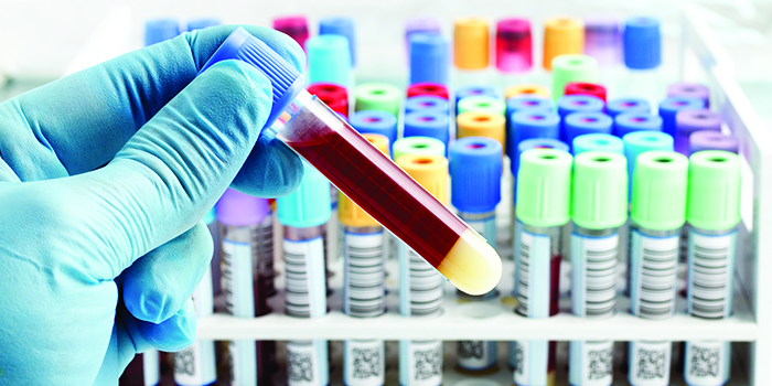 Blood Test May Warn If You’re Going to Get Mesothelioma
